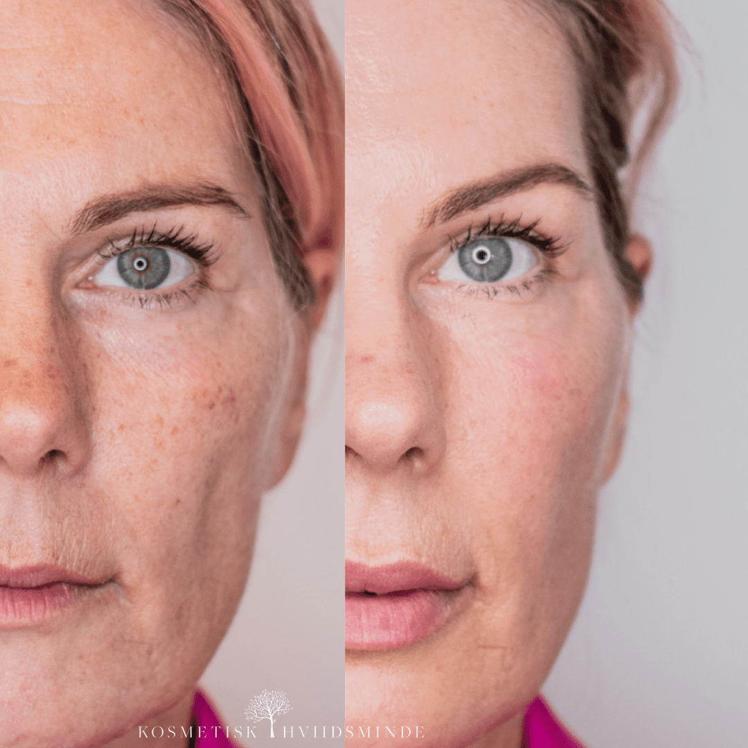 skinceuticals discoloration