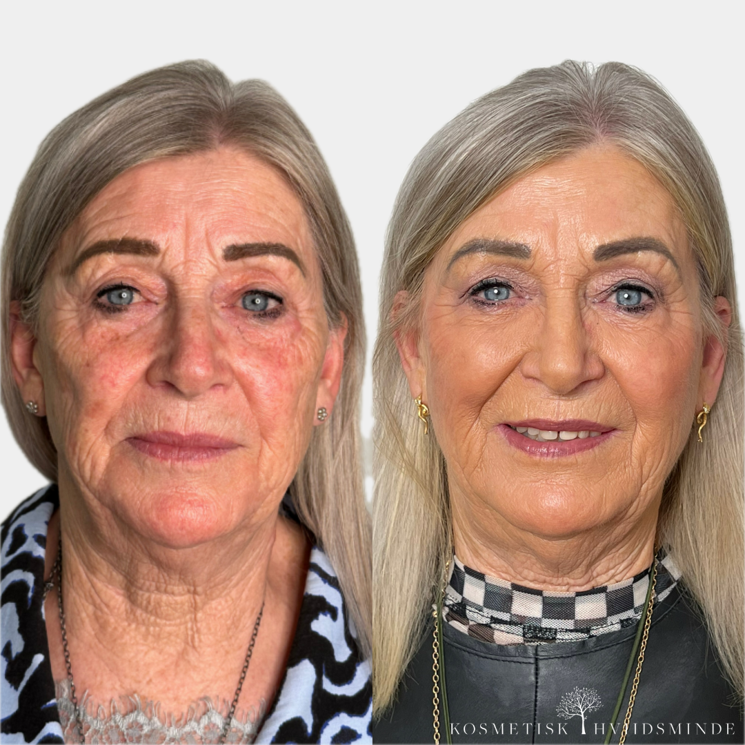 Gurli fullfaceforløb med botox, filler, PRF