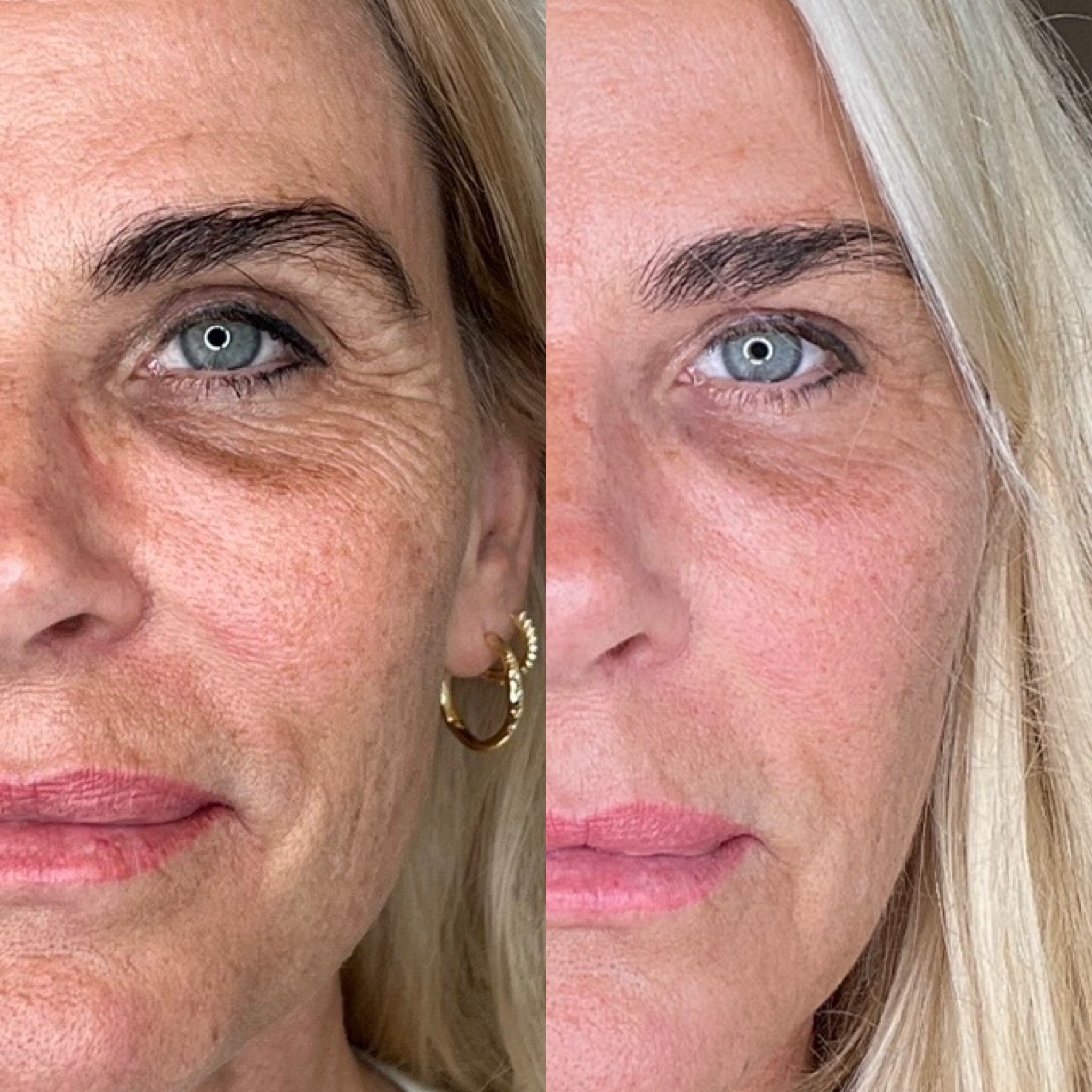 Før og efter billede af radiesse behandling, filler i kæben