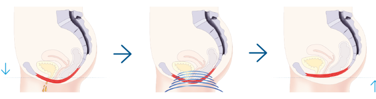 Emsella bækkenbundtræner