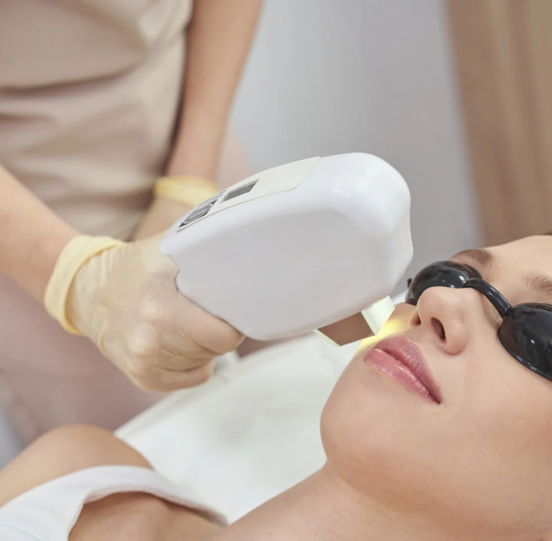 laser til pigmentforandringer, leverpletter, laser behandling